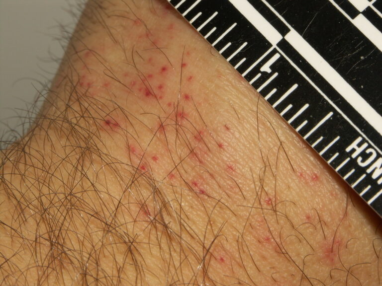 Flea bites grouped together on human skin with ruler